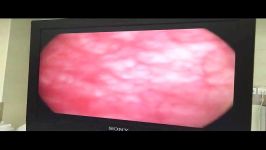 جراحی سرطان مثانه به روش اندسکوپی توسط دکتر حسین کرمی