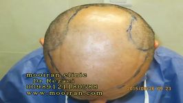 +12 کاشت مو به روش ترکیبی در کلینیک دکتر رضائی روز عمل