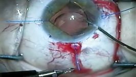 Broken Prolene Scleral Suture IOL exchange MST Chang