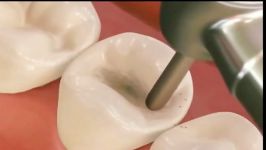 ترمیم پوسیدگی دندان ها کامپوزیت مواد همرنگ دندان