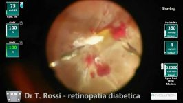 R Evolution Cr vitrectomy with 12000 CPM