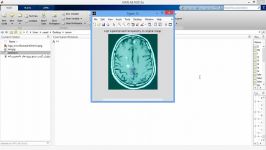 پروژه تشخیص تومور مغزی MATLAB