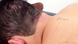 Dry Needling Suboccipitals