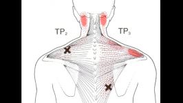 Dry Needling Trapezius