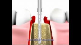 طرز کار ایمپنت دندانی