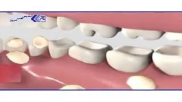 بیماری های دندان پوسیدگی دندان