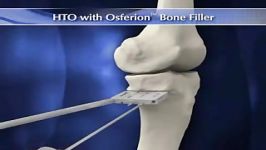 High tibial osteotomy