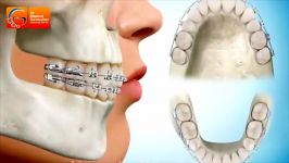 کشیدن دندان برای ارتودنسی  دکتر مسعود داوودیان