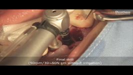 Immediate implantation using Implant Guide