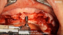 Full mouth rehabilitation with implant supported fixed