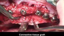 Case 1. Full mouth rehabilitation