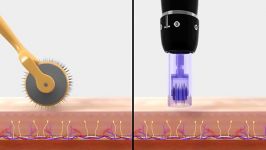 مقایسه میکرونیدلینگ درماپن درمارولر