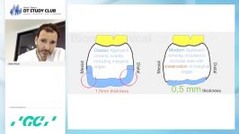 New era in the treatment of worn dentition Part 2