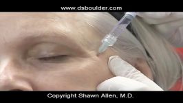 Dermasculpt Microcannula filler technique on cheek