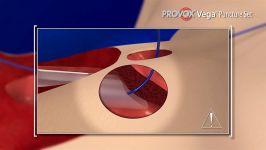 Provox Vega Puncture Set  Primary Puncture