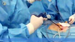 عمل جراحی واریکوسل دو طرفه به روش مینی لاپاروسکوپی