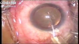 عمل جراحی آب مروارید چشم Cataract Surgery