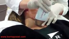 Skin tightening with micro needling RF INFINI