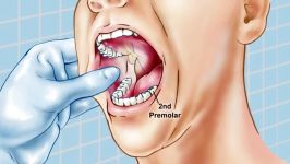 Standard Inferior Alveolar Nerve Block