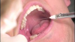 The Dental Box Inferior Alveolar Nerve Block