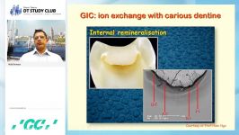 MI restoration of the deeply cavitated caries lesion 02