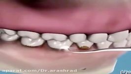 جرم گیری دندانها لثه در یک نگاه