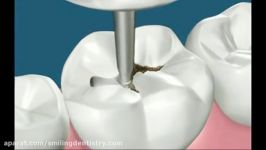 پر کردن دندان مواد همرنگ دندان