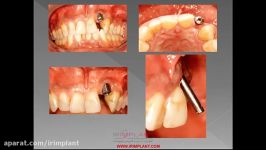 راه حل پروتزی برای زاویه نامناسب قرارگیری ایمپلنت