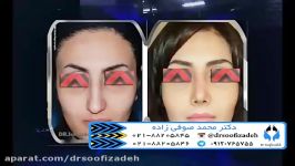 انحراف قوز در بینی های استخوانی