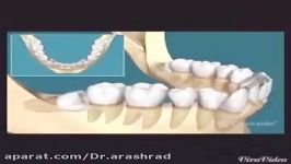 دندان عقل نیمه نهفته