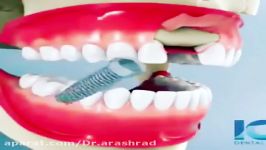 مراحل جایگزینی ناحیه بی دندانی ایمپلنت