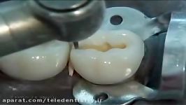 Class II Preparation Amalgam