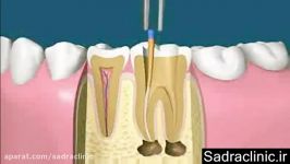 درمان ریشه دندان، عصب کشی