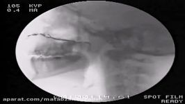 Video Fluoroscopy