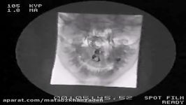 Video Fluoroscopy Townes View