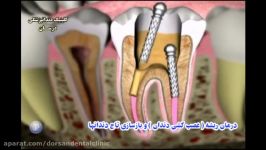 درمان ریشه عصب کشی دندان بازسازی تاج دندانها