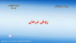 روکش های دندانی