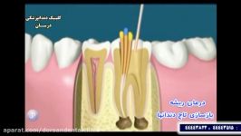 درمان ریشه بازسازی تاج دندان ها