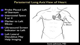 اکوی قلب نمای پارااسترنال Long Axis – قسمت اول