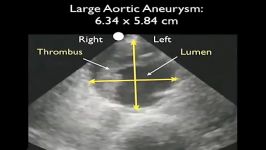سونوگرافی آئورت  آنوریسم