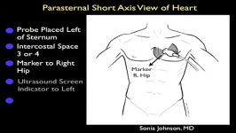 اکوی قلب نمای پارااسترنال Short Axis