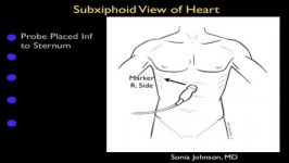 اکوی قلب نمای سبزایفوید Subxiphoid View