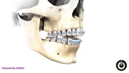 عدم همپوشانی دندانهای قدامی یا Open bite