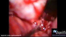 6.جراحی میکروسکوپیک آنوریسم مغزی Aneurysm Clipping