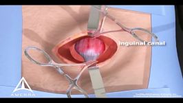 Inguinal hernia