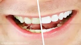 What is Teeth Bleaching  بلیچینگ چیست؟