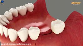 TSIII Fixture With Rigid Abutment