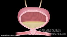 Stress Urinary Incontinence in Women Animation Tutorial