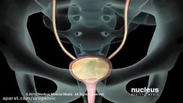 Stress Urinary Incontinence