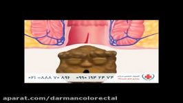 شقاق یا فیشرhttpwww.darmancolorectal.comfissure